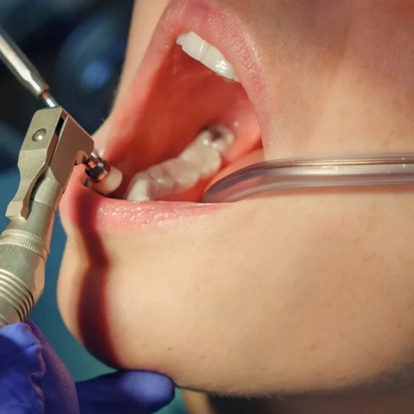 Dental Suction Tips (Saliva Ejector) – Dentomart.com
